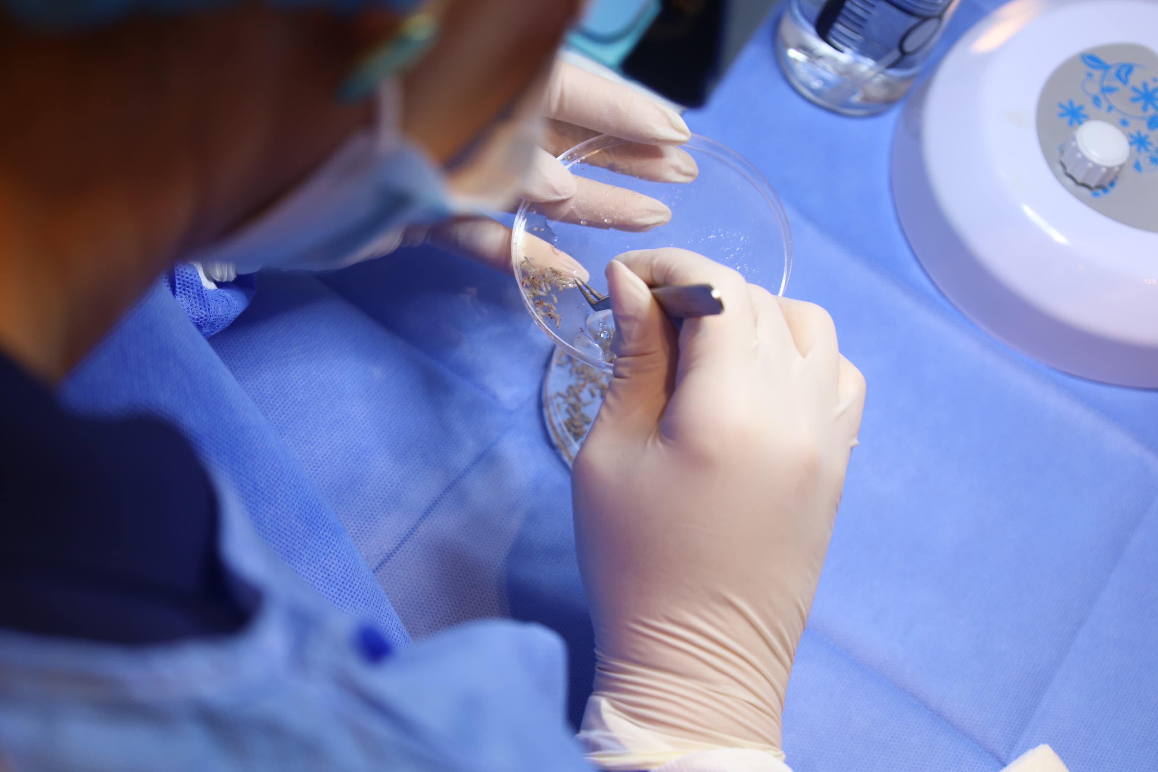 Hair Transplant
