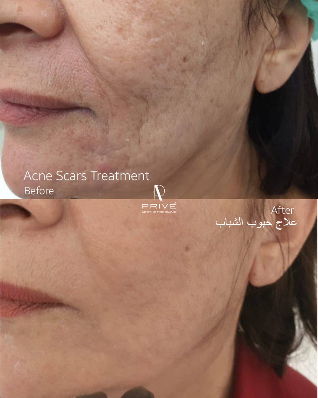 Dermal Fillers