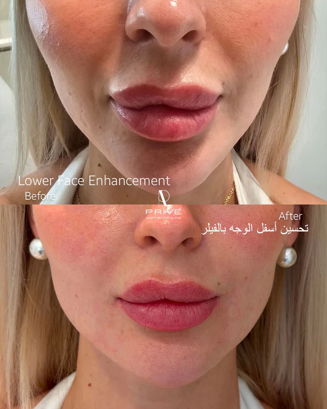 Skin Boosters